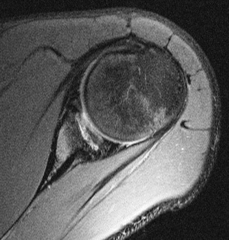 Figure 2 for case Osteochondritis dessicans of the glenoid